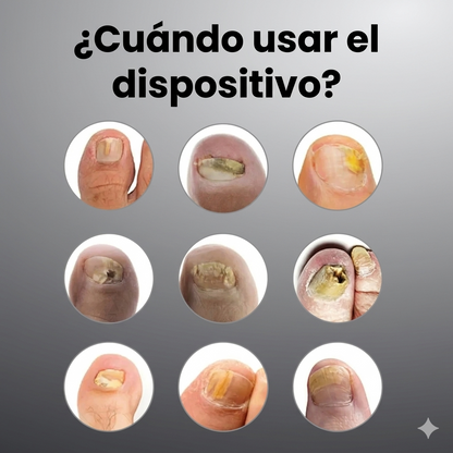 AlivioVital™-Dispositivo antifúngico